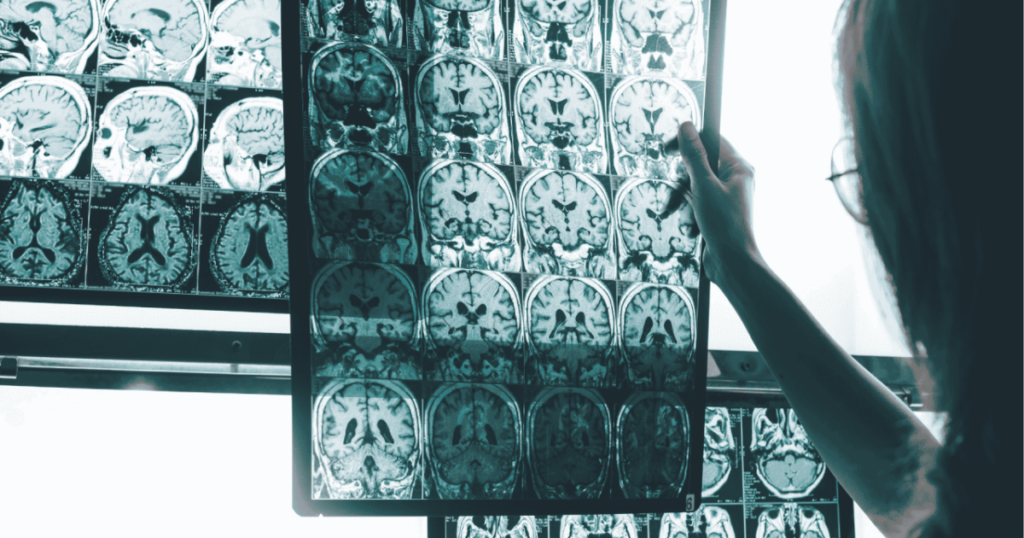 Un índice nuevo ayuda a medir el Alzheimer y vuelve a evidenciar que la enfermedad se adelanta años