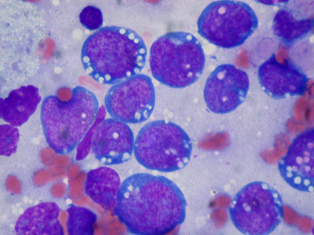 Especialistas rechazan las promesas de curar el cáncer con la dieta y recuerdan el peso de la obesidad